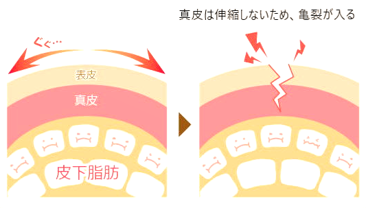 ダイエット 肉割れ ダイエット 肉割れ